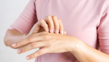 Dermatitis Atópica