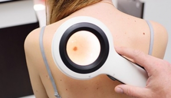 Cáncer de piel: Consejos para prevenirlo.